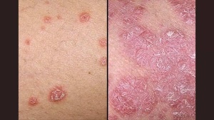 Excess belly fat may trigger skin infection - psoriasis; science says